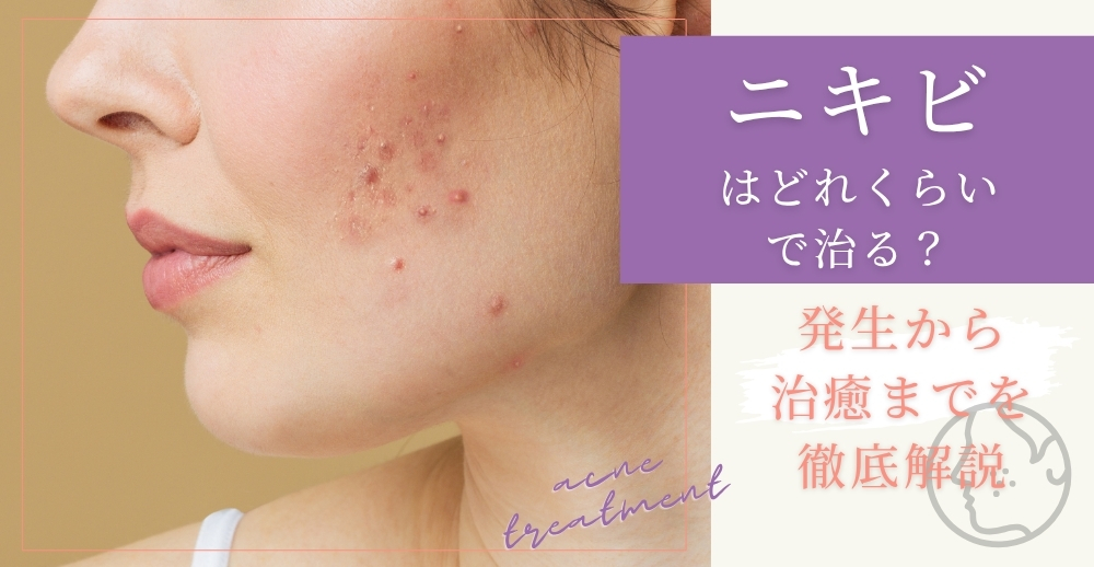 ニキビはどれくらいで治る？発生から治癒までを徹底解説