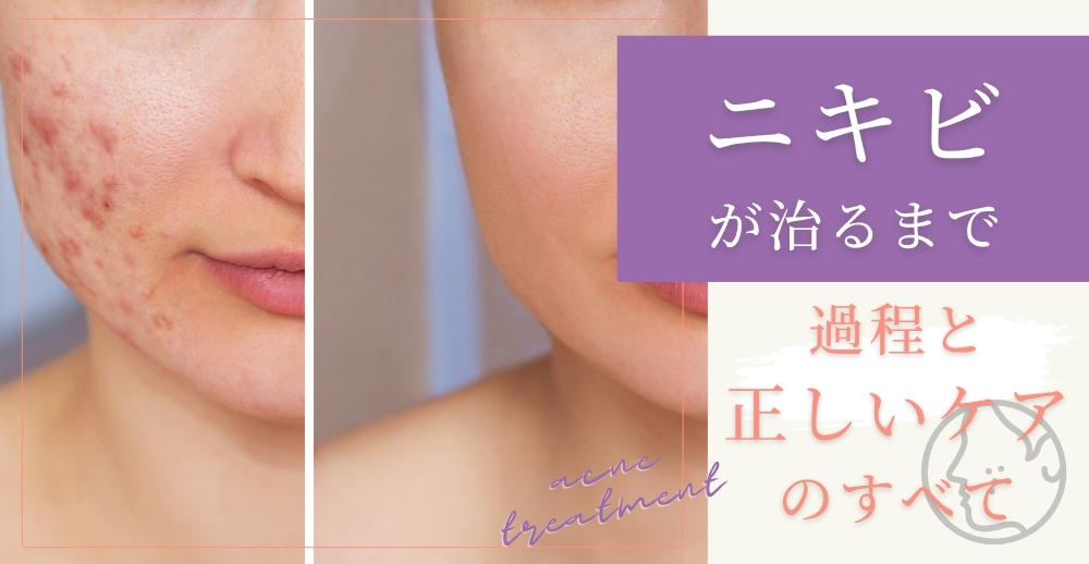 ニキビが治るまでの過程と正しいケアのすべて