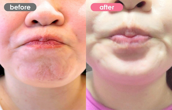 ボトックス(アゴ)-01