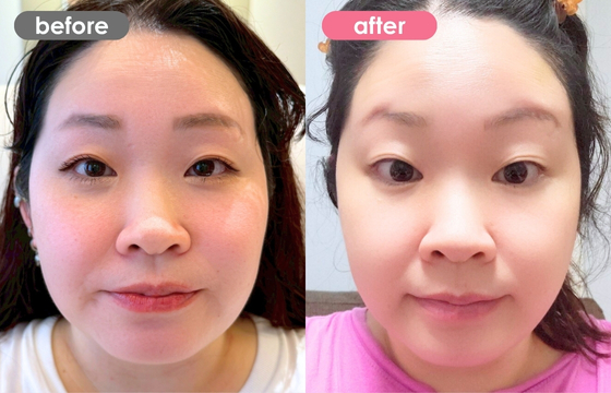 ボトックス(エラ)-01