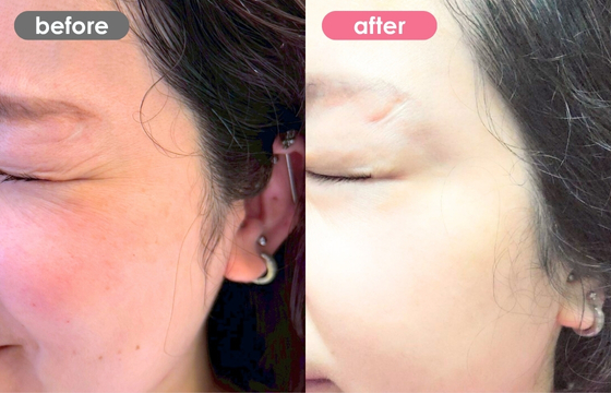 ボトックス(目尻)-01