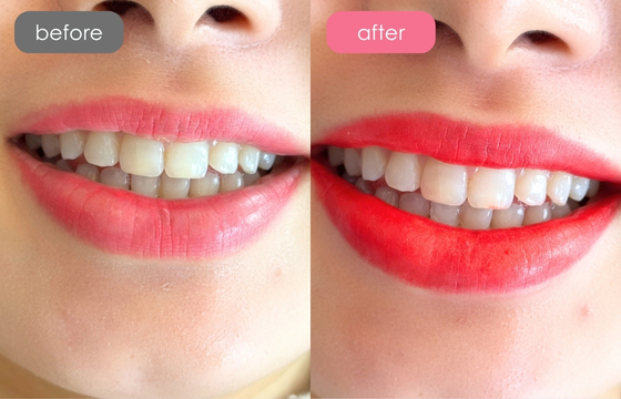 唇アートメイク-09 02