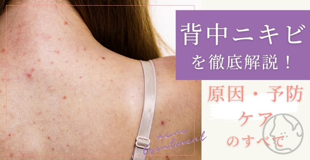 背中ニキビを徹底解説！原因・予防・ケアのすべて