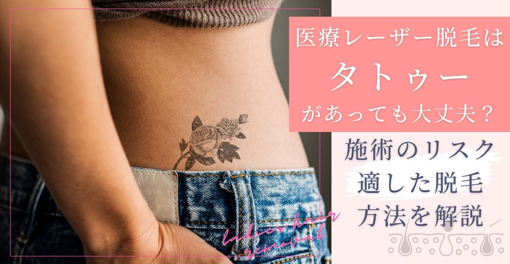 医療脱毛のレーザー脱毛はタトゥーがあっても大丈夫？施術のリスク・適した脱毛方法を解説