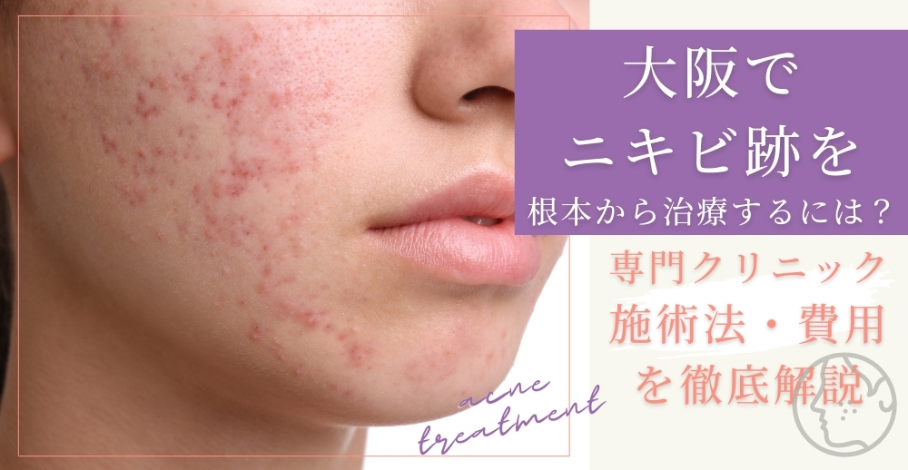 大阪でニキビ跡を根本から治療するには？専門クリニック・施術法・費用を徹底解説