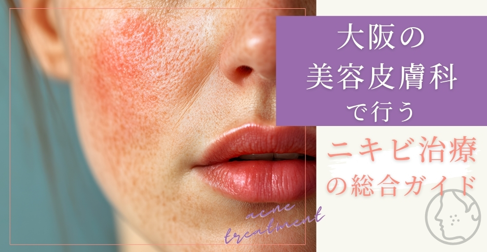 大阪の美容皮膚科で行うニキビ治療の総合ガイド