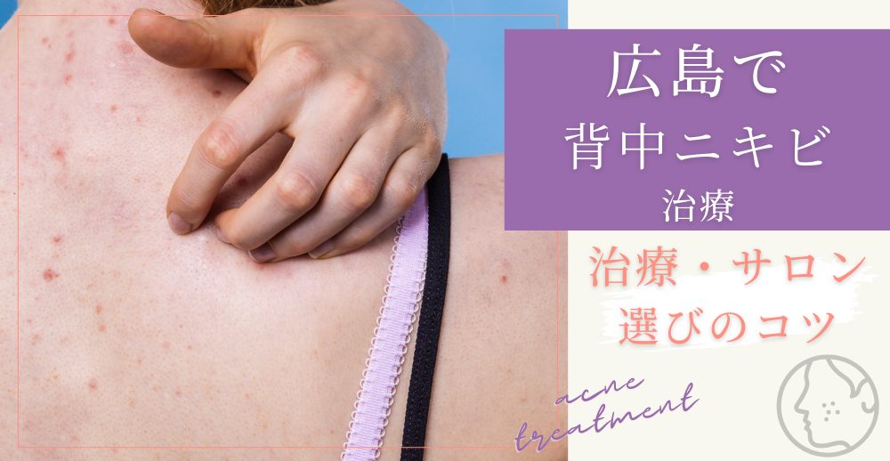 広島で背中ニキビを治したい人のための治療・サロン選び