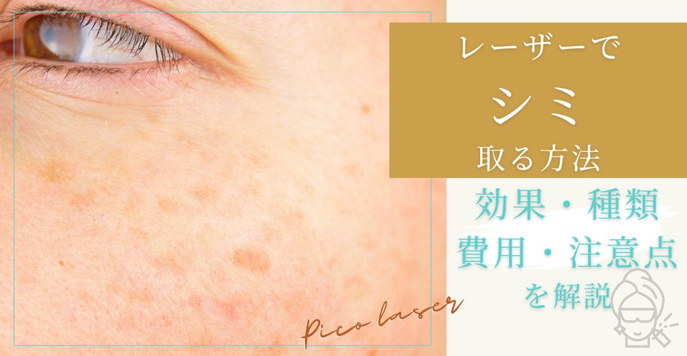 レーザーでシミを取る方法｜効果・種類・費用・注意点