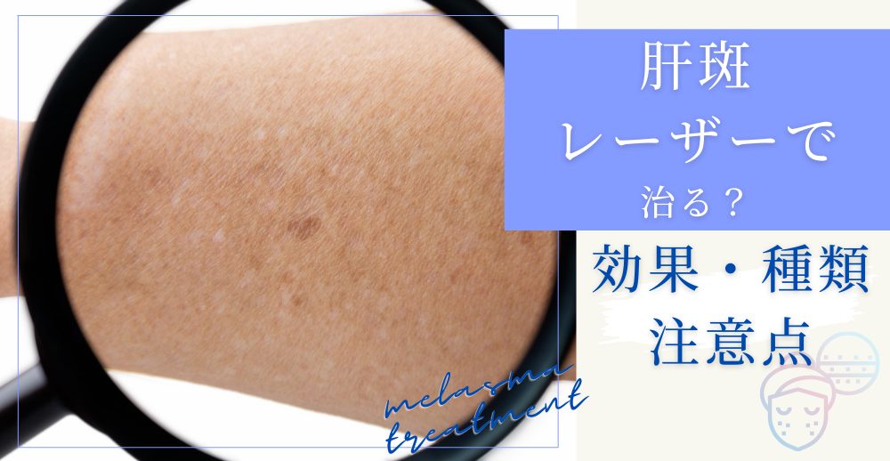肝斑はレーザーで治る？効果・種類・注意点