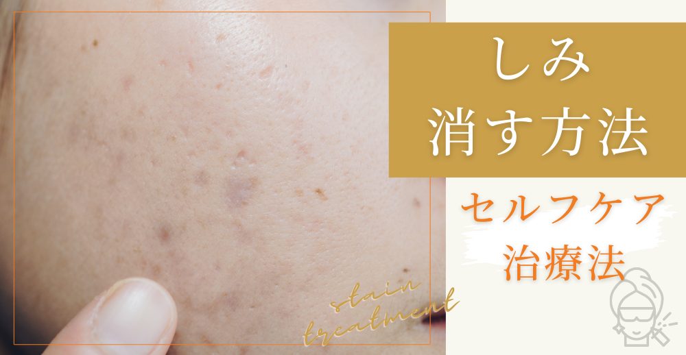 しみを消す方法｜種類別のセルフケアと美容皮膚科治療