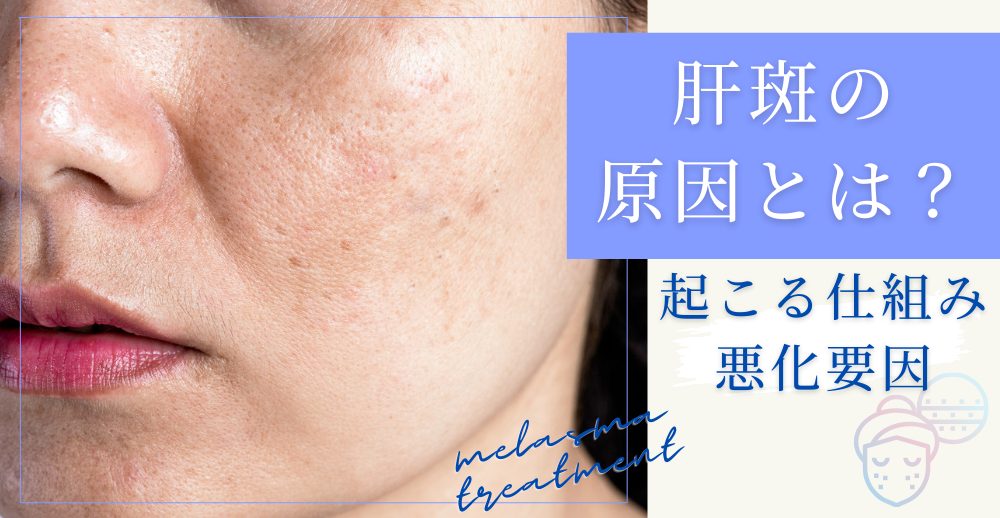 肝斑の原因とは？起こる仕組みと悪化要因