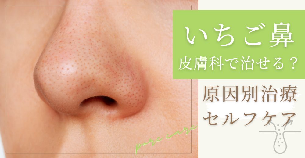 いちご鼻は皮膚科で治せる？原因別の治療とセルフケア