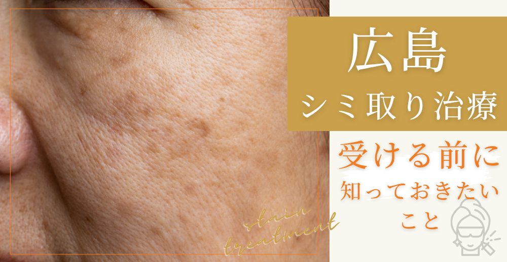 広島でシミ取り治療を受ける前に知っておきたいこと