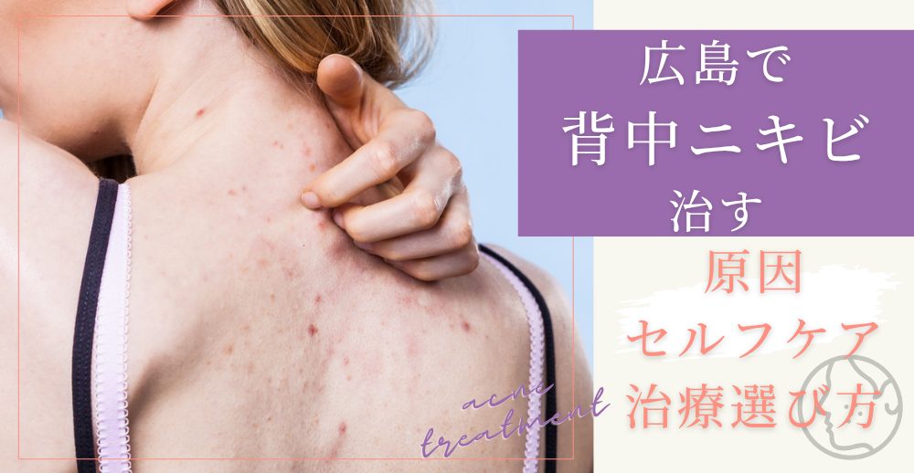 広島で背中ニキビを治す：原因・セルフケア・クリニック治療の選び方